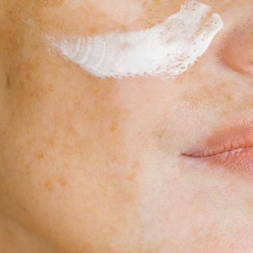 The Best Natural Ingredients for Fading Hyperpigmentation